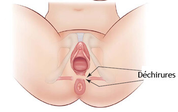 accouchement incontinence urinaire