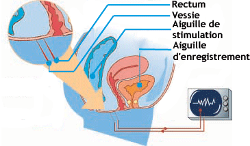 incontinence biofeeback