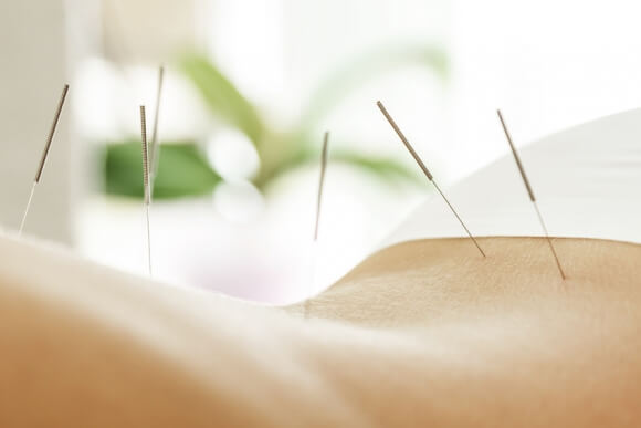 Electroacupuncture, la piste prometteuse contre l’incontinence