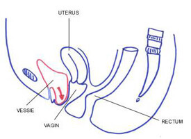 prolapsus incontinence