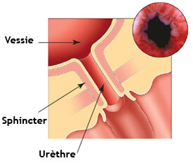 incotinence injection péri urétrale