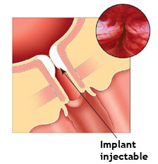 incontinence implant urèthre