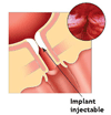 chirurgie contre fuites urinaires