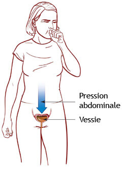 pression abdominale et incontinence urinaire