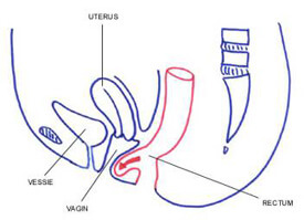 prolapsus incontinence urinaire