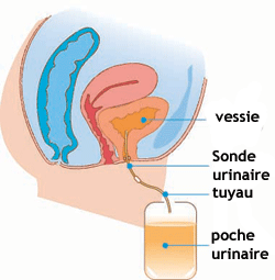 incontinence sondage femme