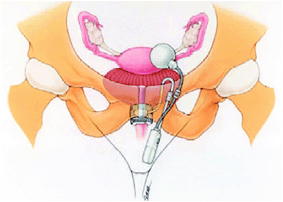 sphincter urinaire femme